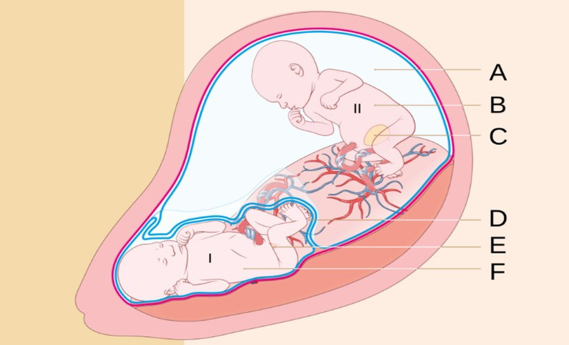 Twin to Twin Transfusion Syndrome